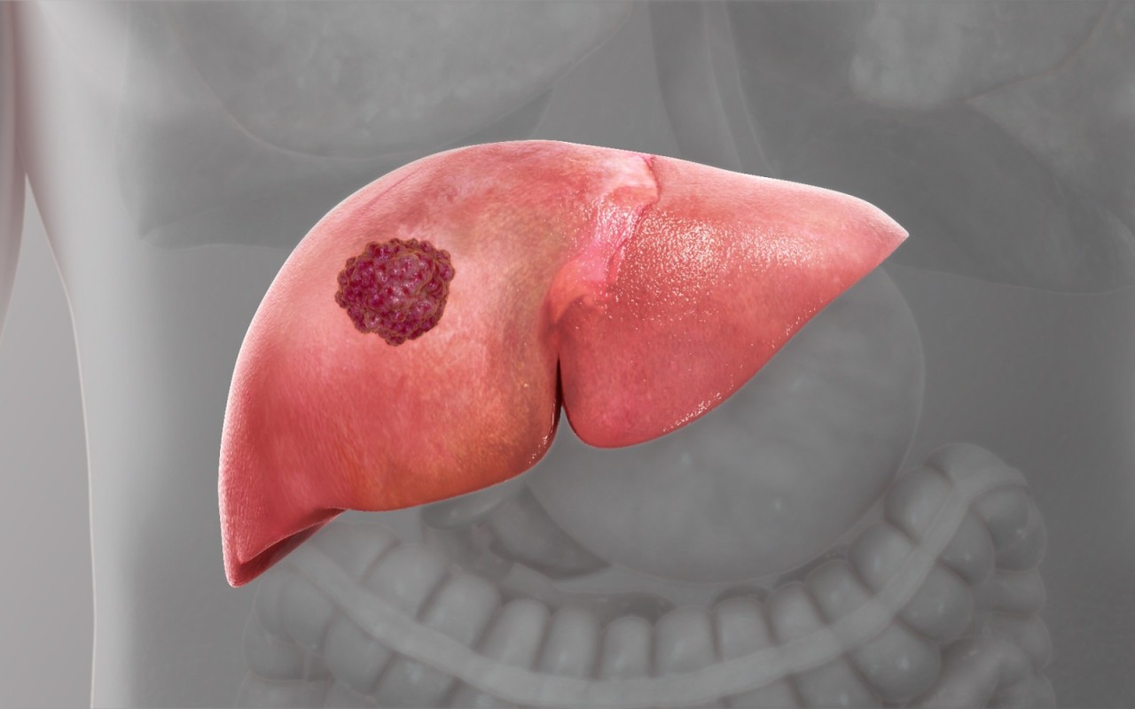 Cách Phòng Ngừa Ung Thư Gan Hiệu Quả 1