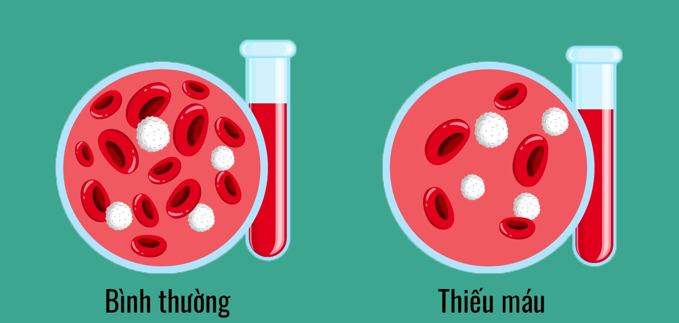 Nguyên Nhân Thiếu Máu Và Những Phương Pháp Điều Trị Hiệu Quả 1