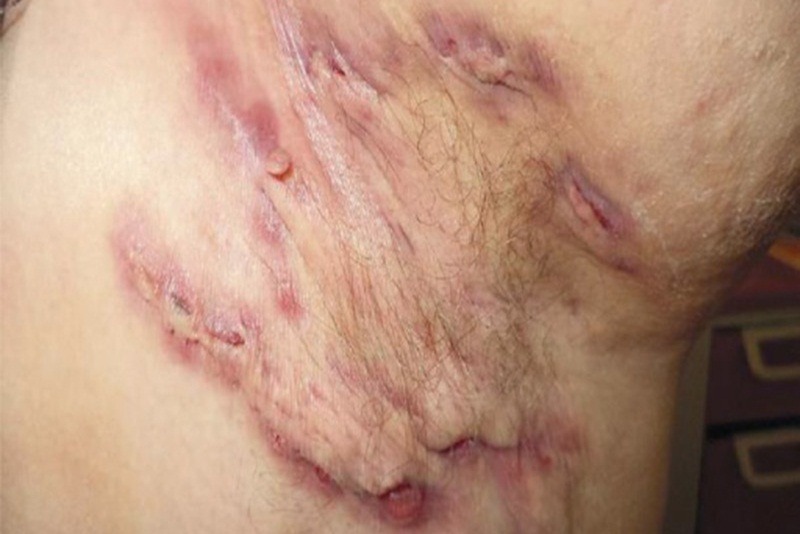 Những Bệnh Ngoài Da Hiếm Gặp 1