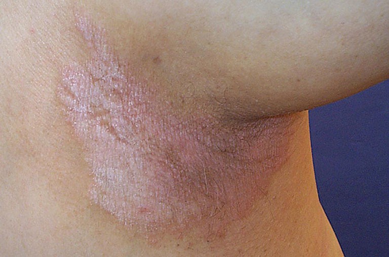 Những Bệnh Ngoài Da Hiếm Gặp 2
