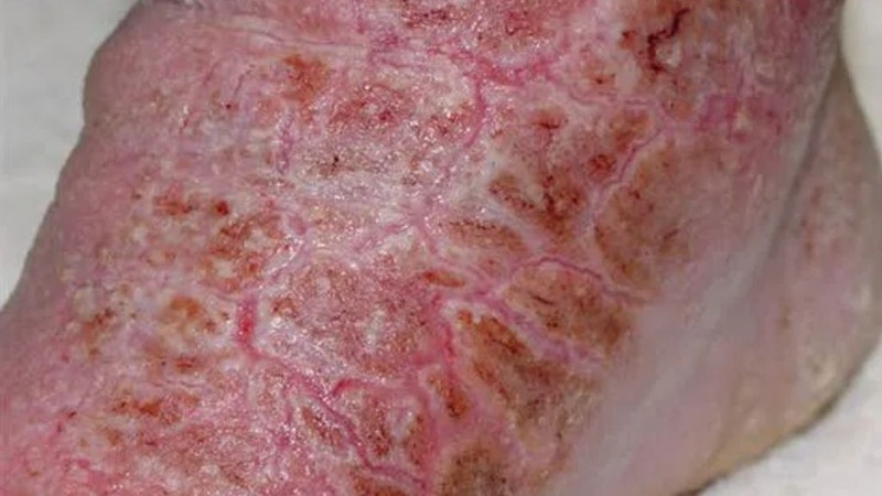 Những Bệnh Ngoài Da Hiếm Gặp 4