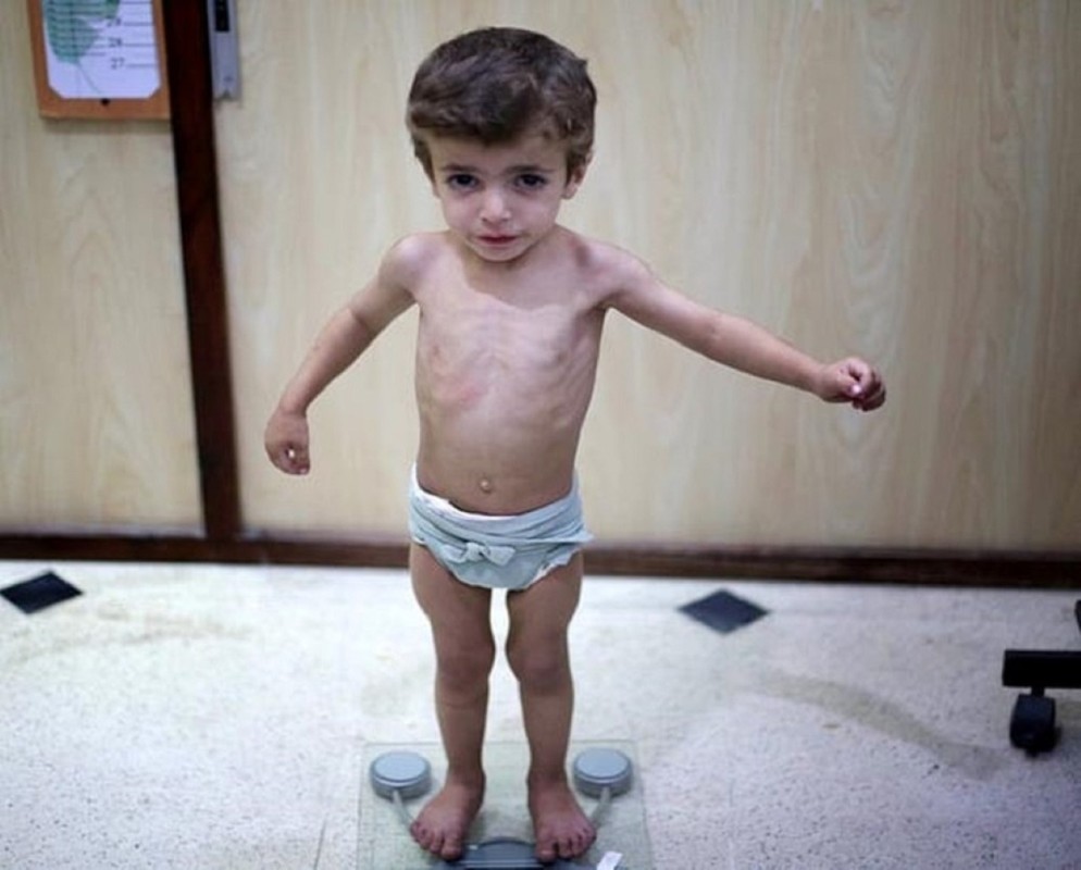 Dấu Hiệu Nhận Biết Trẻ Bị Còi Xương 1