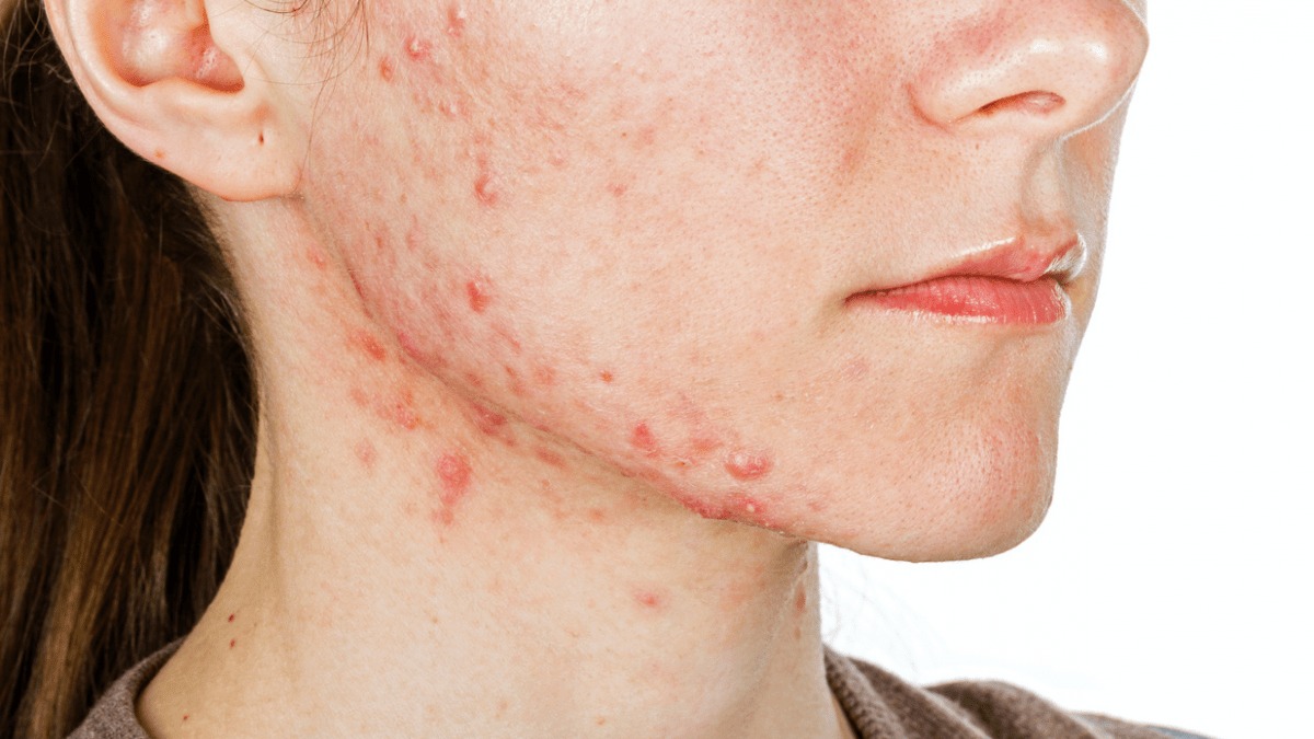 Rối loạn nội tiết ở nữ giới 2