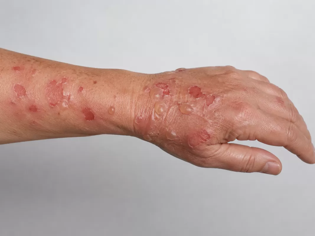 Nổi bọng nước trên da: Cẩn trọng với bệnh tự miễn Pemphigus